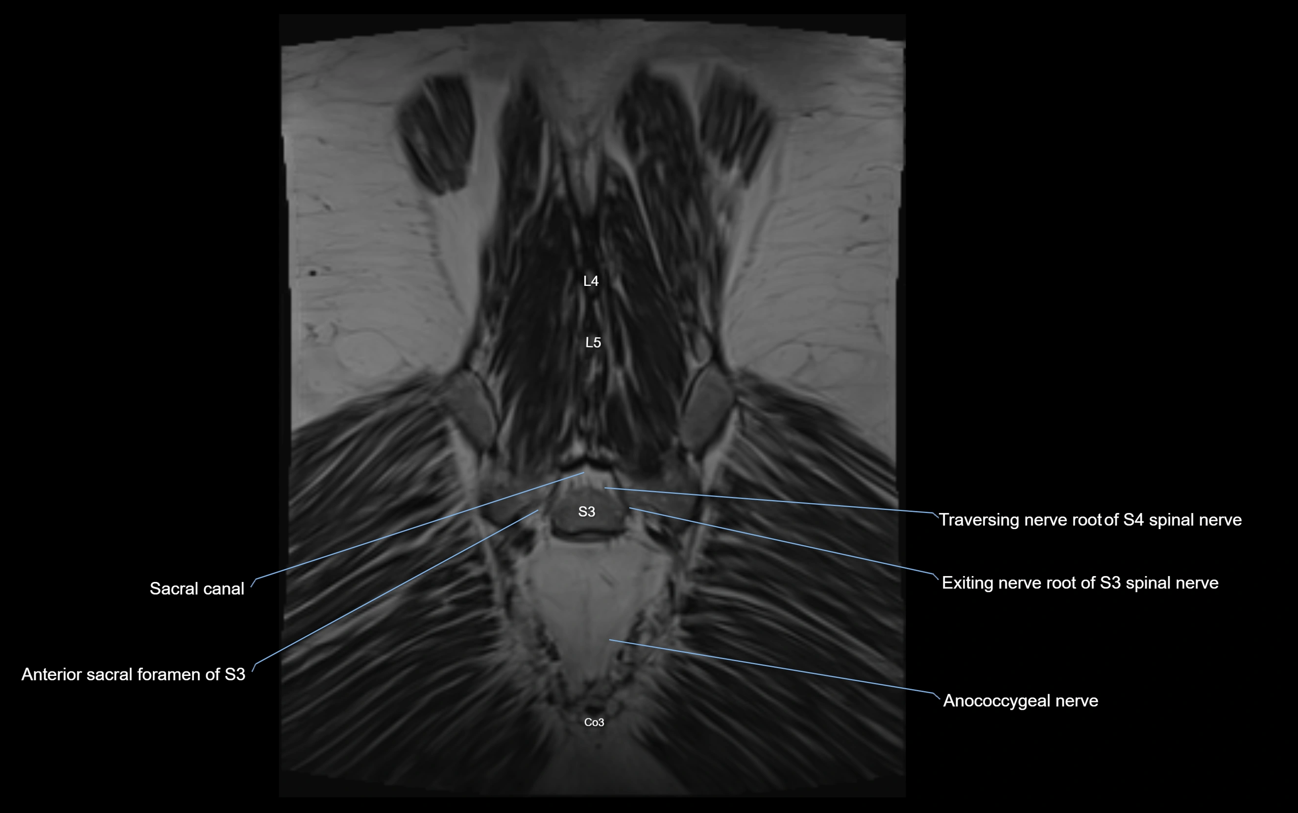 MR lumbosacral plexus cross sectional anatomy 3T  radiology  image-img-09001-00075.webp